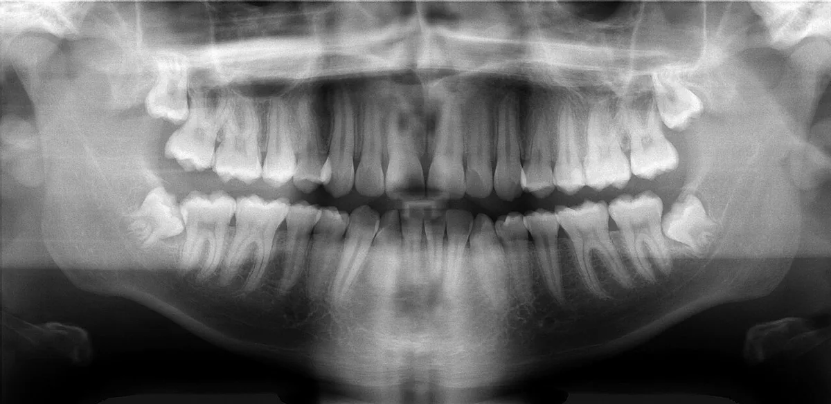 Basic panoramic radiograph