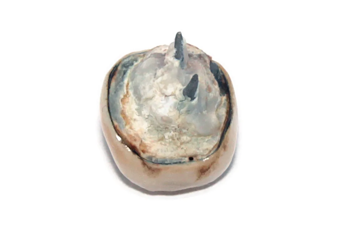 Detached-dental-crown-angle-front