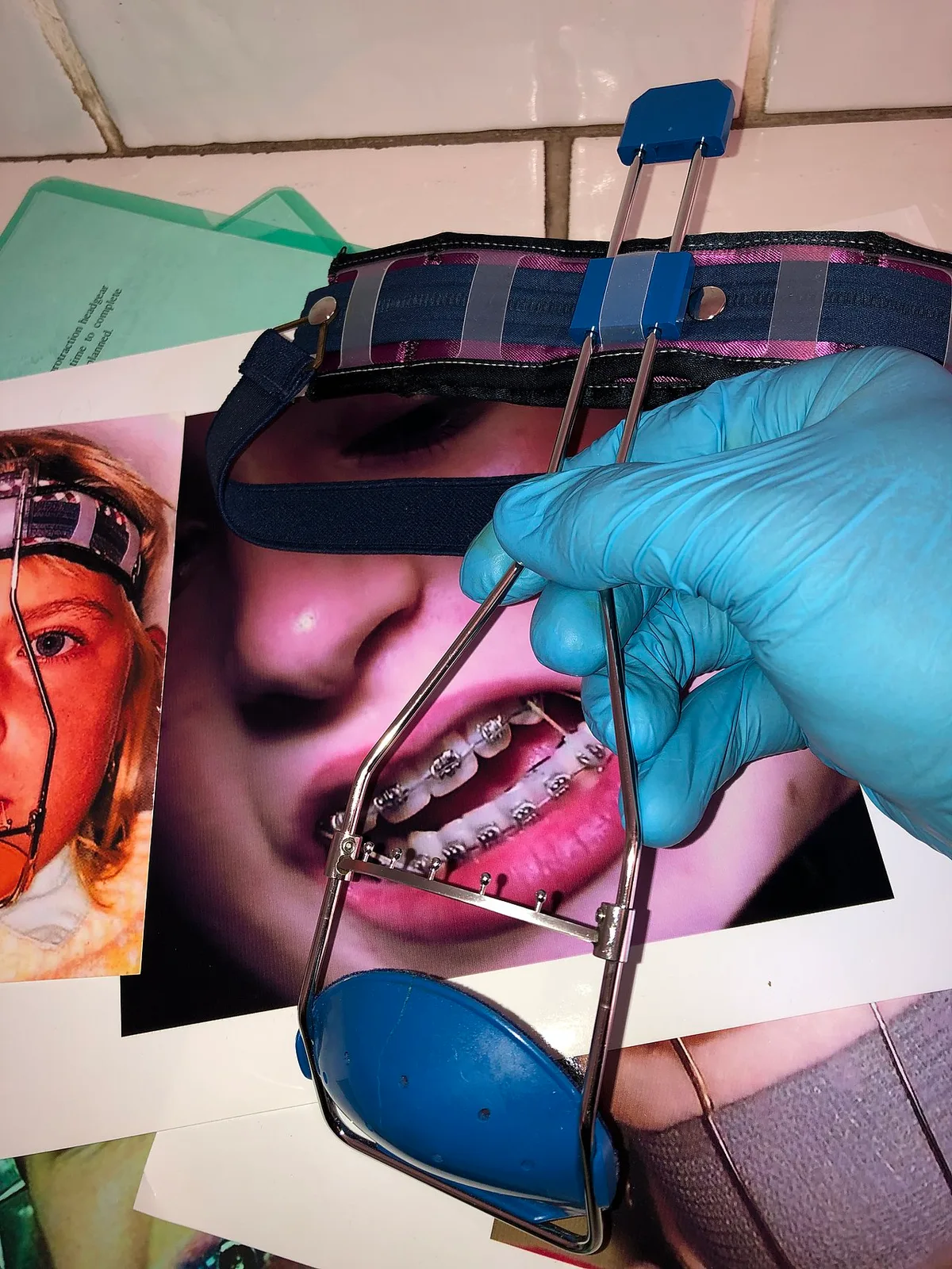 ORTHODONTIC REVERSE-PULL HEADGEAR TÜBINGER MODEL FITTING FOR FEMALE PATIENT 16 HOURS DAILY WEAR