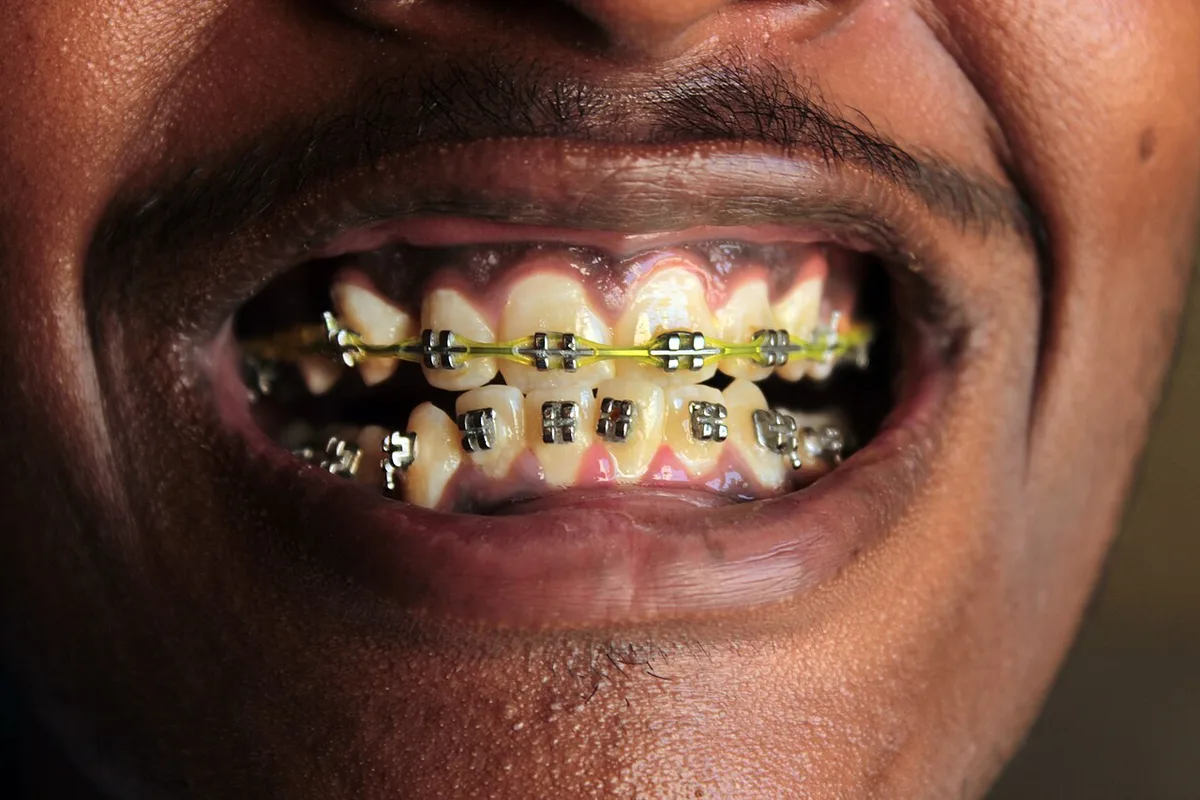 Teeth Braces (2)