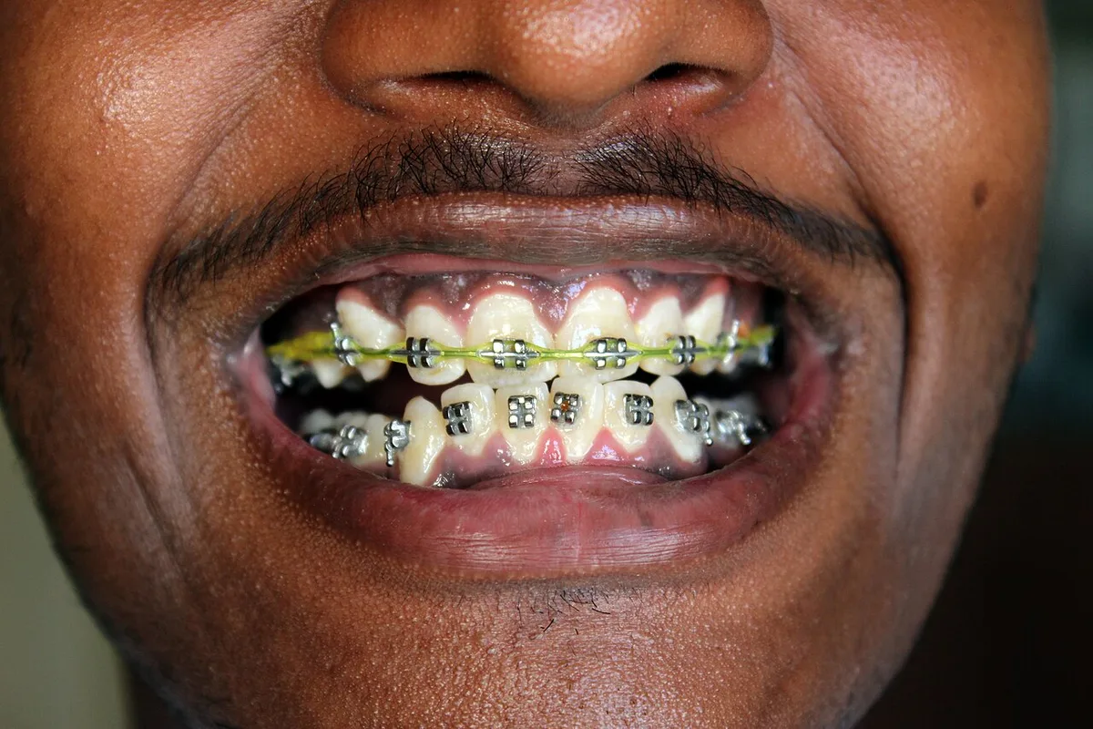 Teeth Braces (1)