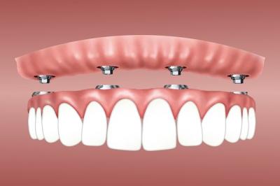 implant dentaire - dentiste sceaux